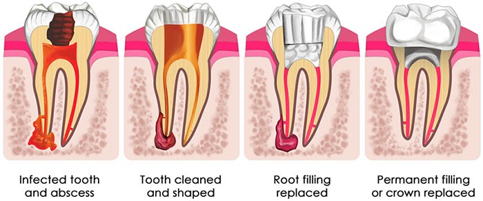 Root Canal Cost Melbourne Get Affordable Root Canal Treatment