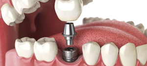 Dental Implants Melbourne